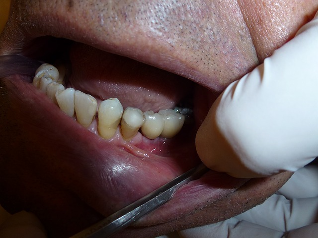 odstraňování zubního kamene